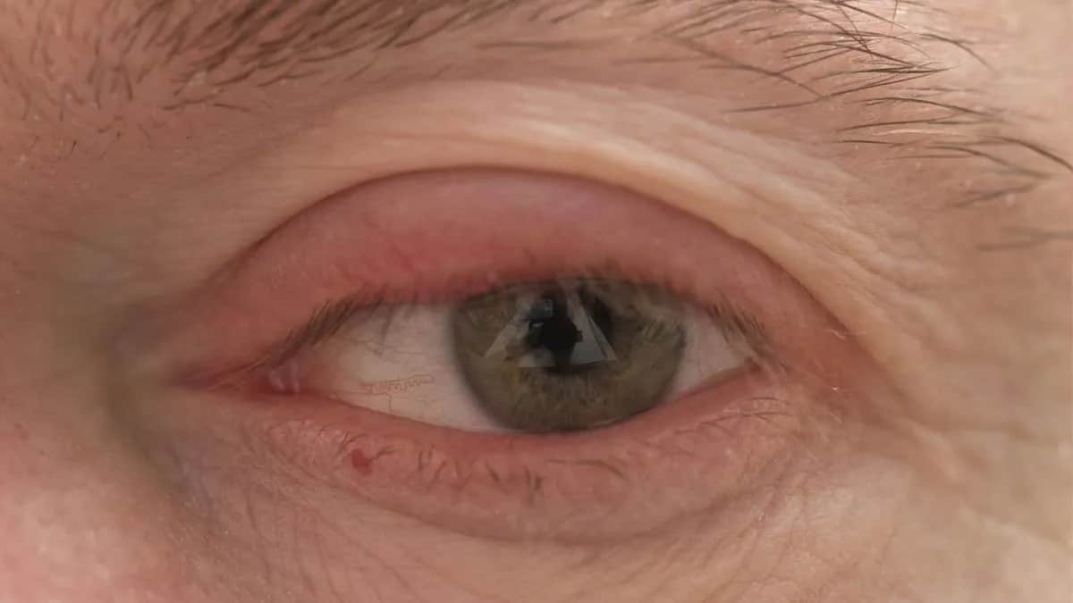 Jakie leki na opuchnięte powieki skutecznie przynoszą ulgę?