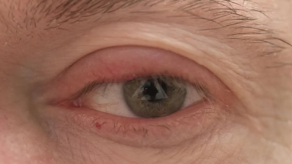 Jakie leki na opuchnięte powieki skutecznie przynoszą ulgę?