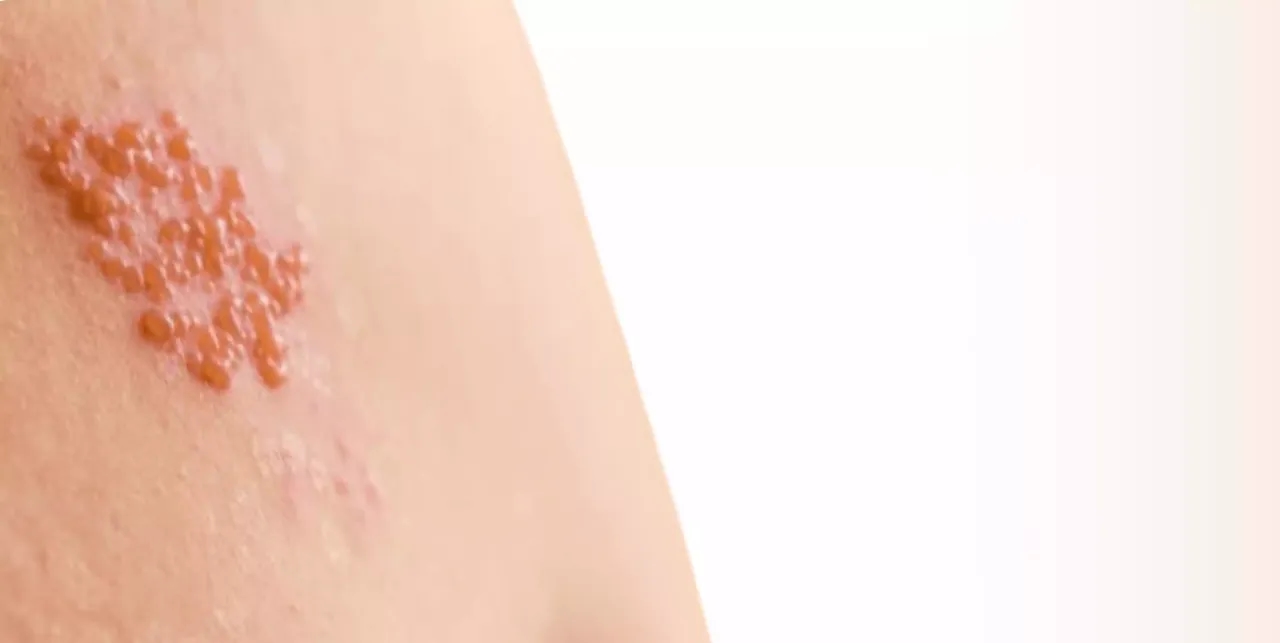 Skuteczne leki na ospę bez recepty, które złagodzą swędzenie i ból