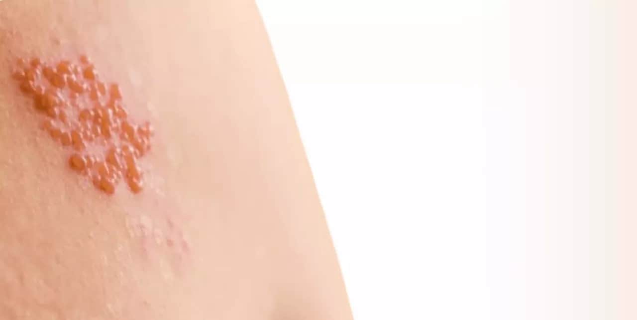 Skuteczne leki na ospę bez recepty, które złagodzą swędzenie i ból