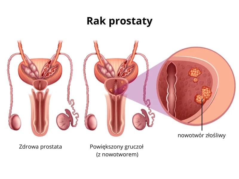 Prostata objawy choroby - jak rozpoznać niebezpieczne symptomy