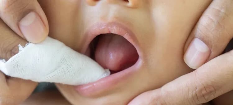 Skuteczne sposoby na pleśniawki u dziecka bez recepty - co wybrać?