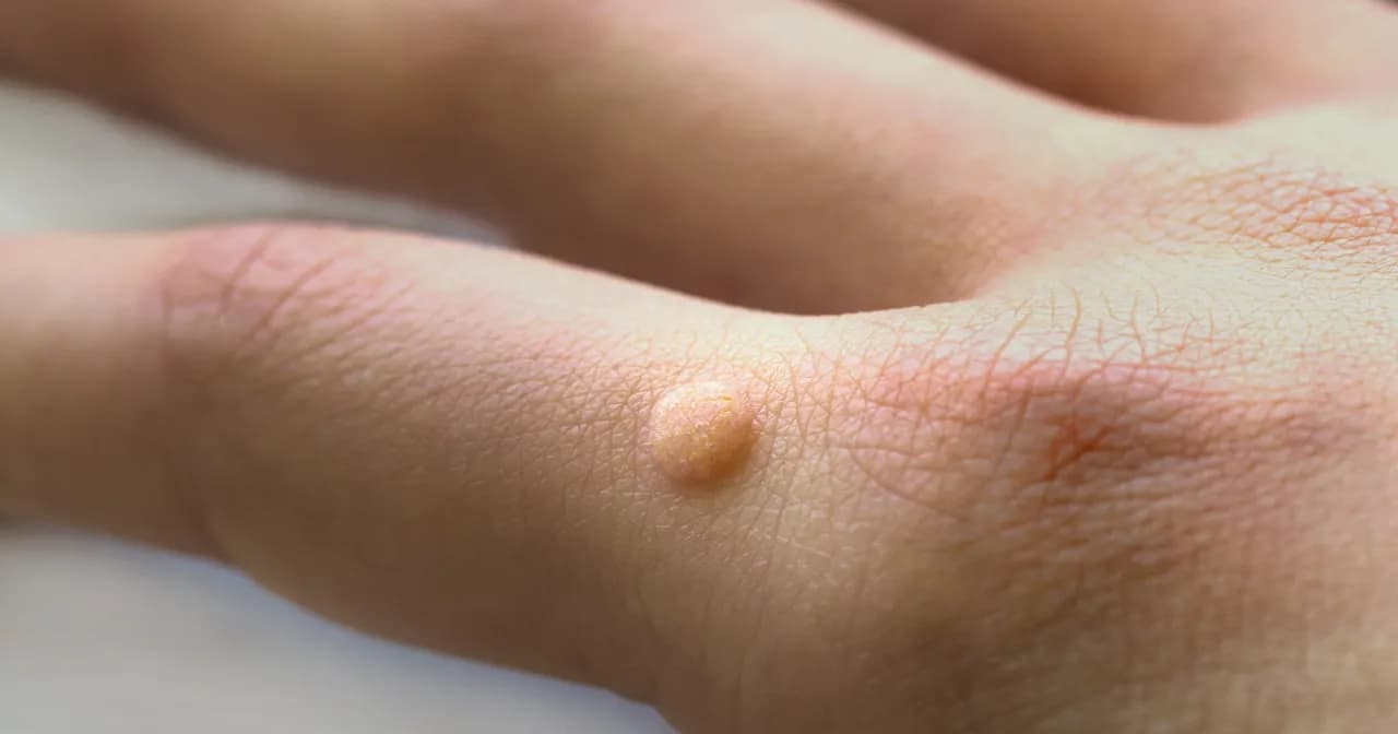 Skuteczne środki na kurzajki bez recepty, które naprawdę działają