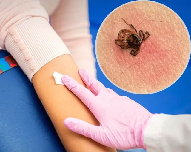 Kto wystawia skierowanie na badanie boreliozy i jak je uzyskać