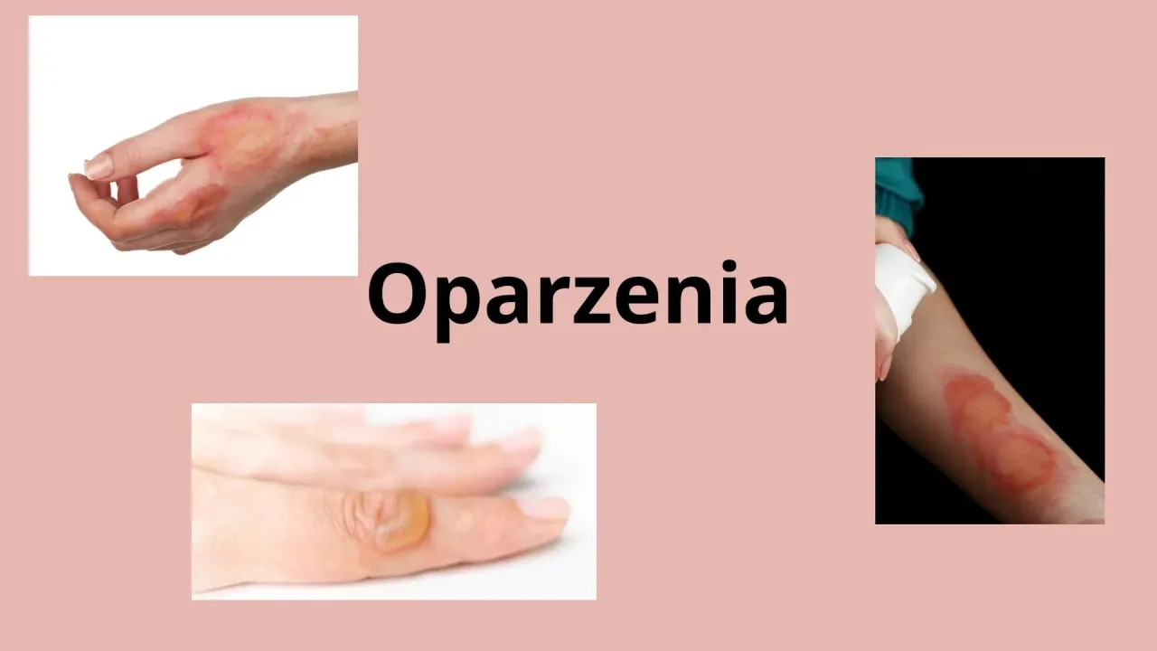 Do jakiego lekarza z oparzeniem? Kluczowe informacje, które musisz znać