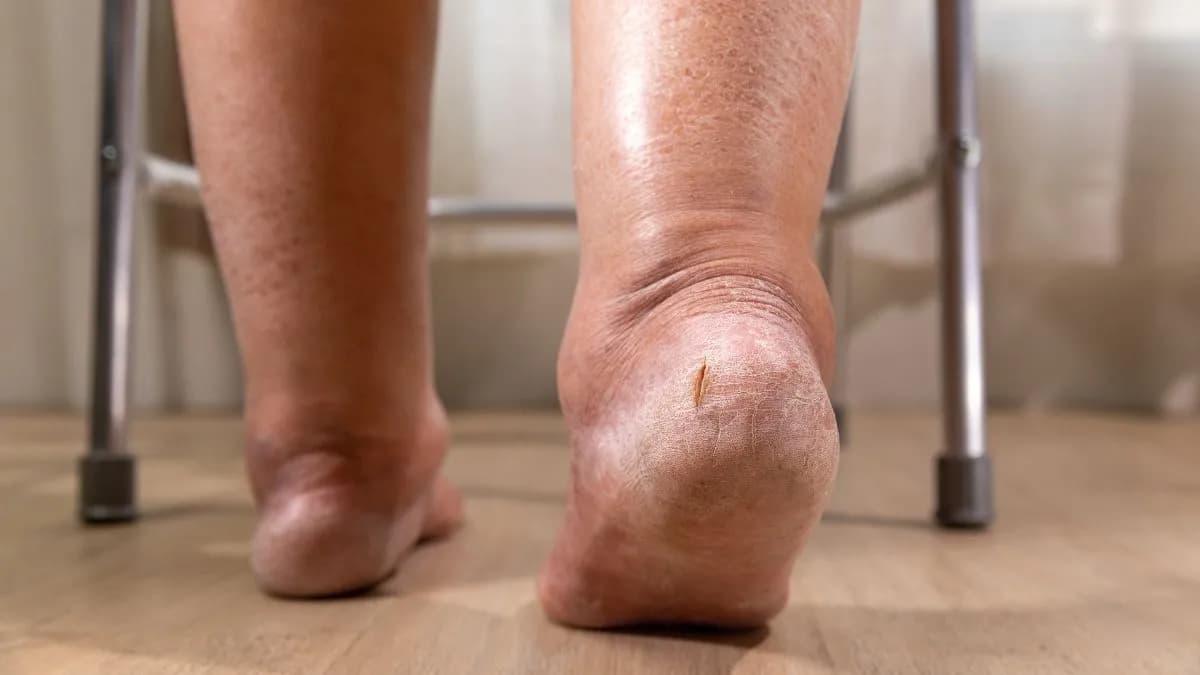 Jakie leki na opuchnięte kostki skutecznie zmniejszą ból i obrzęk